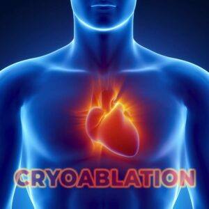 Cryoablation for Afib - human body with a heart