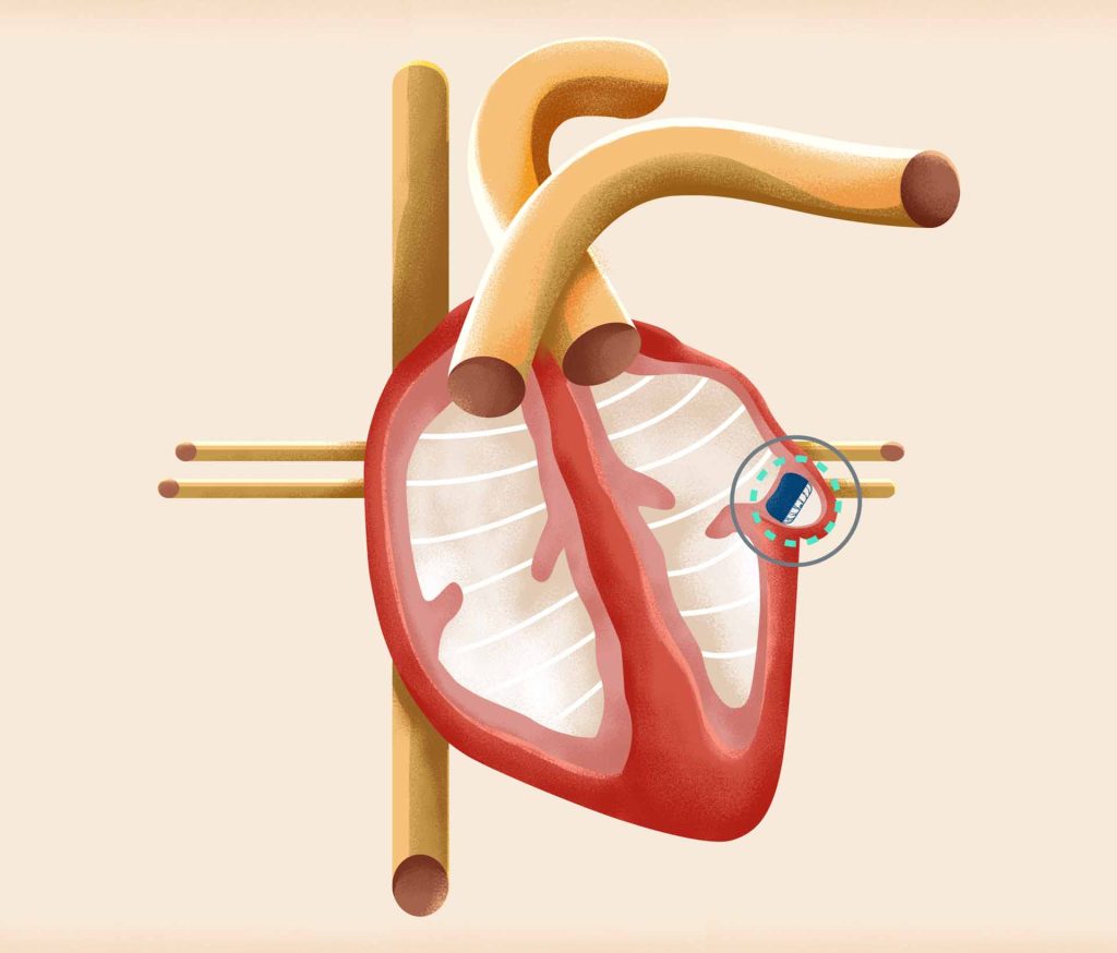 Watchman-Procedure-for-Afib