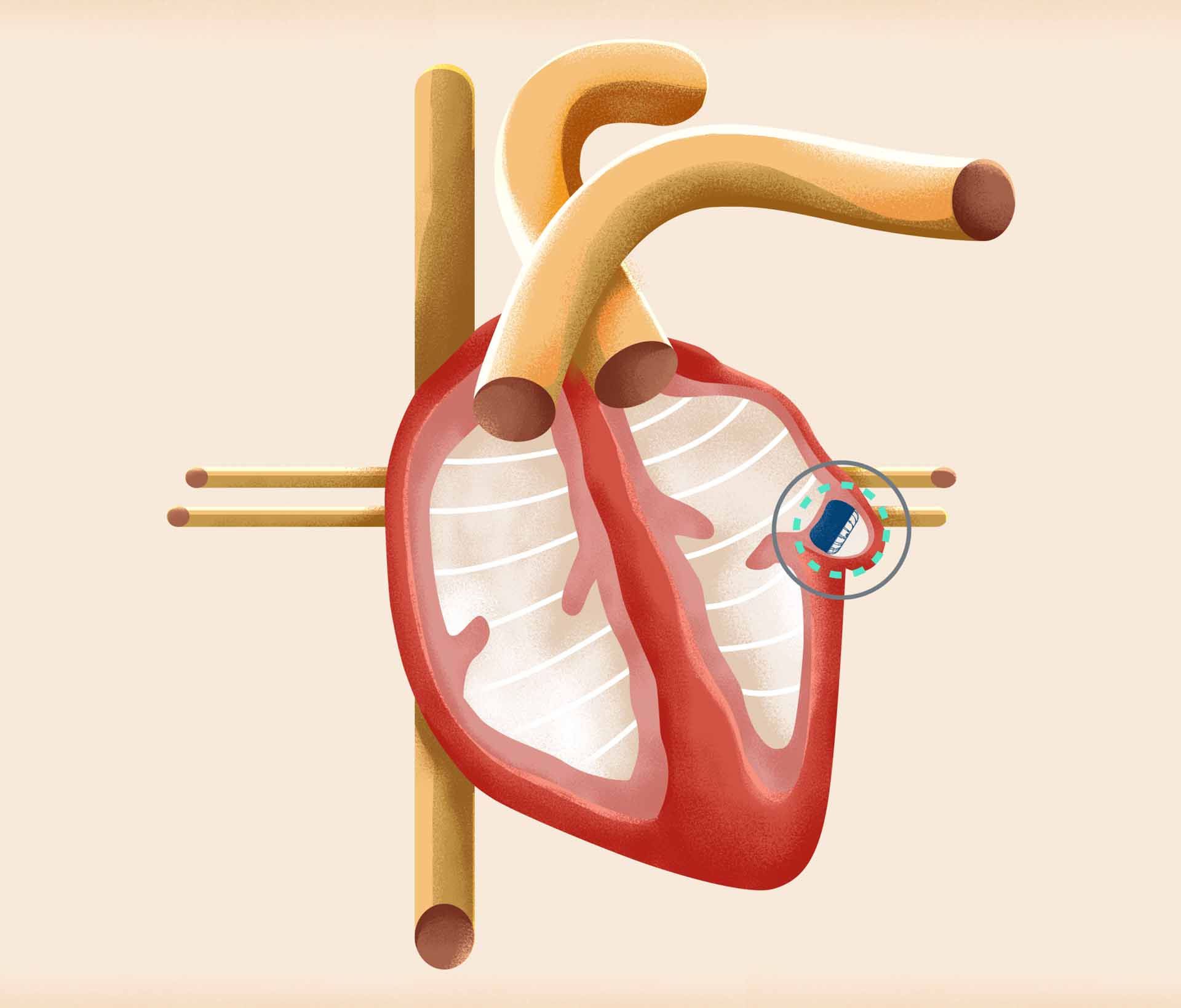 Watchman Procedure for Atrial Fibrillation FixAFib