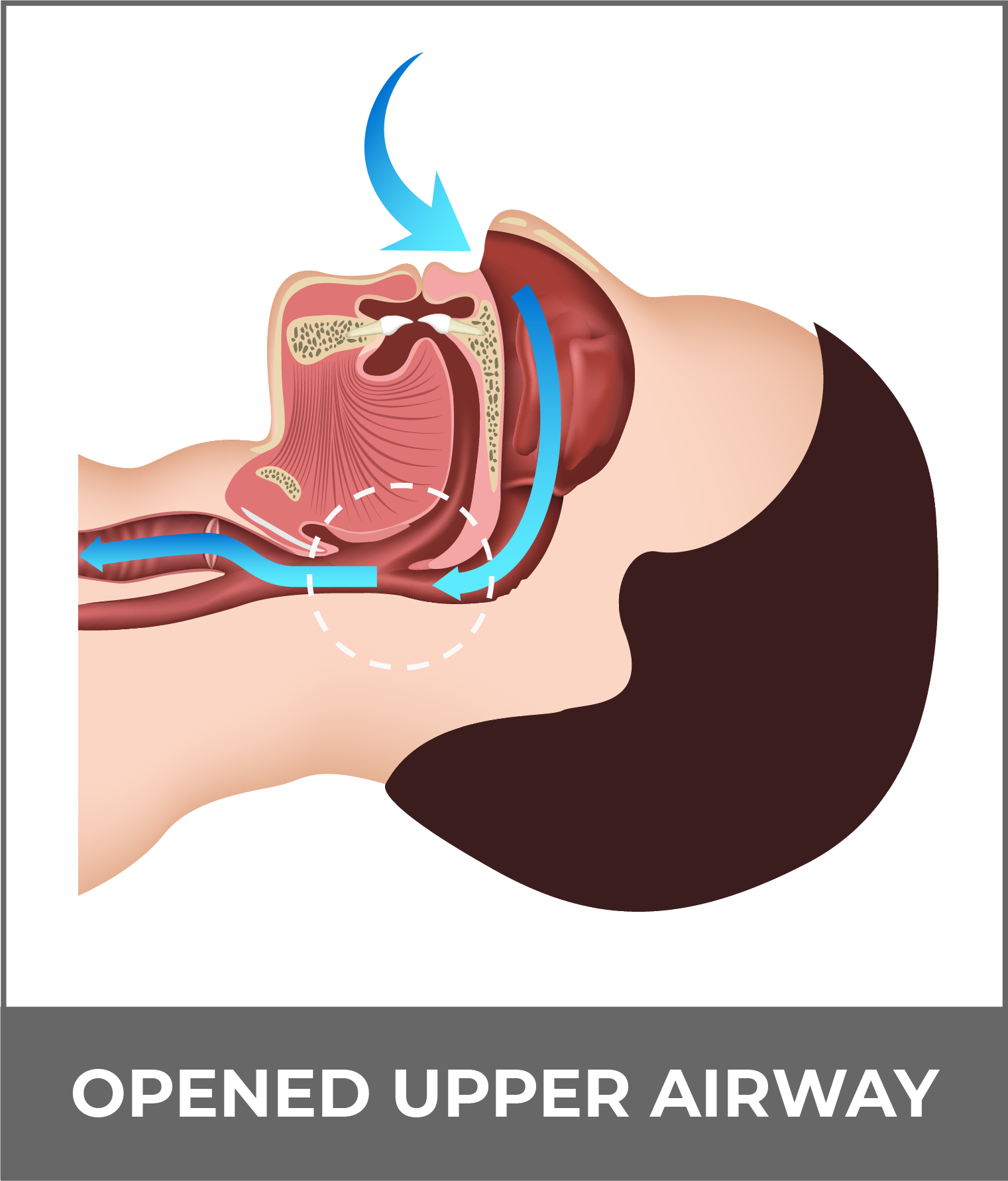 Sleep Apnea - FixAFib