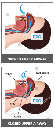 Sleep Apnea - FixAFib