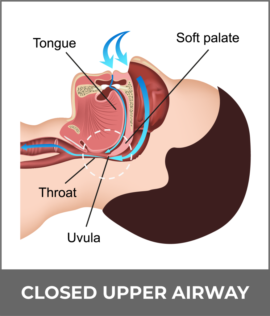 SLEEP_APNEA_B